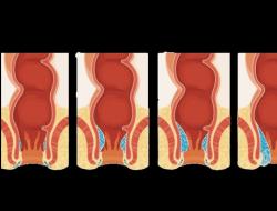 Šta uzrokuje analni svrab i šta učiniti ako anus nepodnošljivo svrbi?