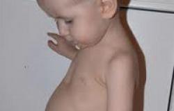 Shenjat e rakitave tek foshnjat, trajtimi, shkaqet, fazat e rakitave tek fëmijët Si fillon rakitizmi tek një fëmijë