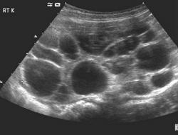 Mörkning i njuren på ultraljud och vad kan det vara?