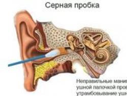 Bagaimana cara menghilangkan sumbat lilin dari telinga sendiri di rumah?