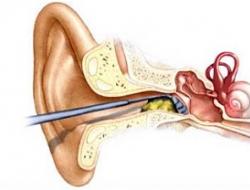 Kotoran telinga menyumbat telinga - apa yang harus dilakukan?